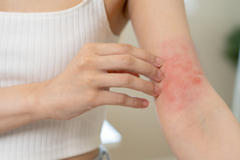 What Actually is Eczema?